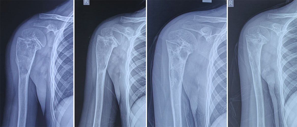 Healing of a simple bone cyst after steroid injection Healing of a simple bone cyst after steroid injection