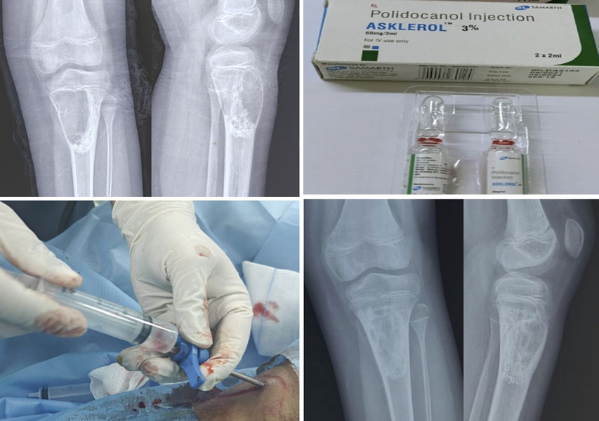 Healing of an aneurysmal bone cyst after sclerotherapy Healing of an aneurysmal bone cyst after sclerotherapy