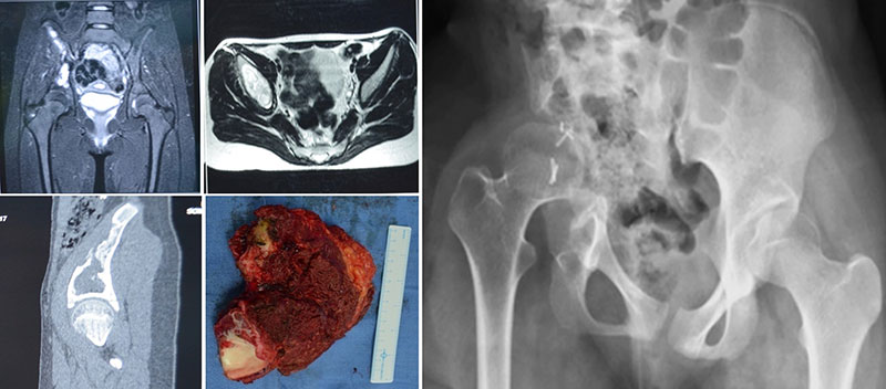 Hip transposition after pelvic tumor resection, a limb-salvage reconstruction that preserves the lower limb while removing the diseased pelvic bone Hip transposition after pelvic tumor resection, a limb-salvage reconstruction that preserves the lower limb while removing the diseased pelvic bone