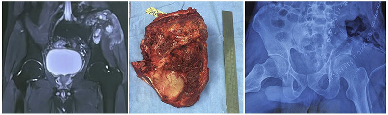 Iliac bone tumor resection, removing the tumor while preserving the hip joint Iliac bone tumor resection, removing the tumor while preserving the hip joint