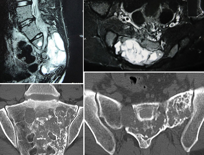 Imaging features of sacral chondrosarcoma Imaging features of sacral chondrosarcoma