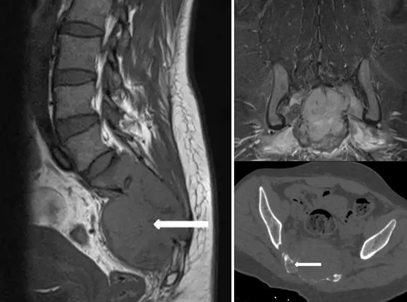 Imaging of a giant cell tumor of the sacrum Imaging of a giant cell tumor of the sacrum