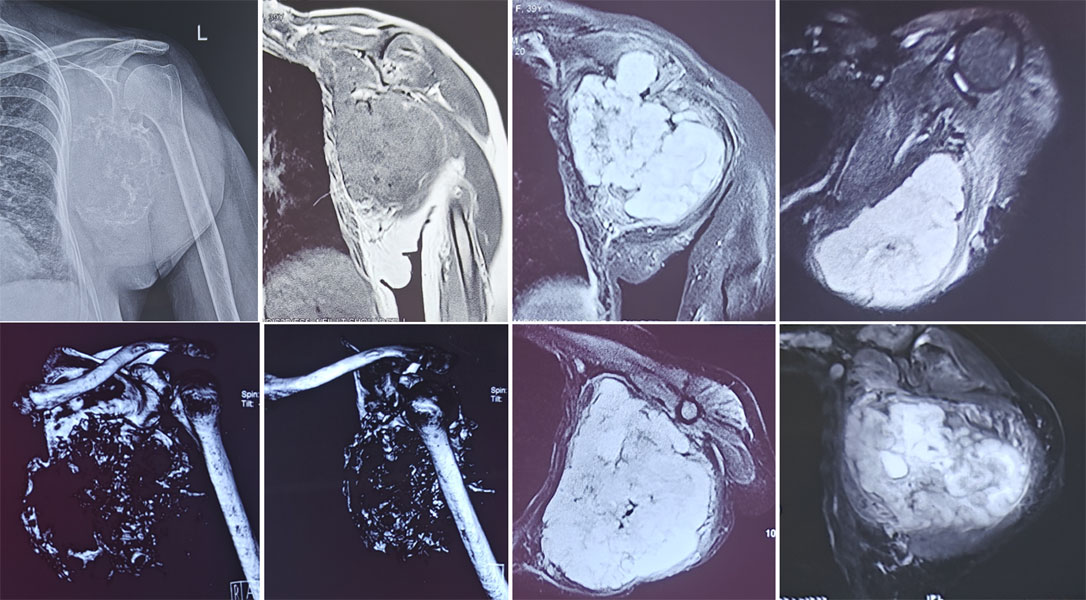 Imaging of chondrosarcoma of the scapula Imaging of chondrosarcoma of the scapula