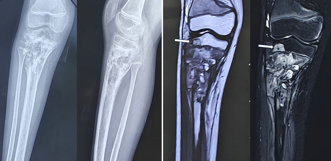 Importance of the growth plate in pediatric bone tumor surgery