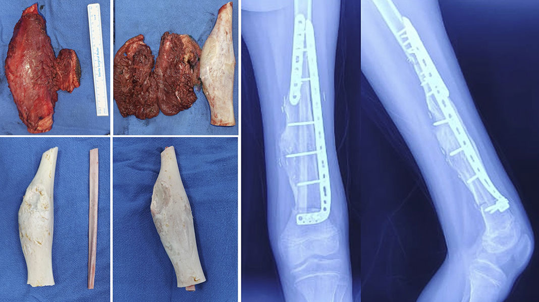 Intercalary resection and biological reconstruction