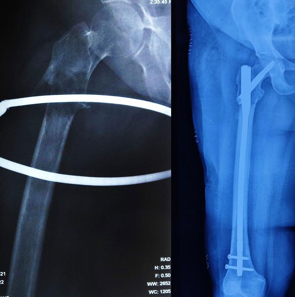 Intramedullary fixation of a pathological fracture in the subtrochanteric femur caused by metastatic thyroid cancer Intramedullary fixation of a pathological fracture in the subtrochanteric femur caused by metastatic thyroid cancer