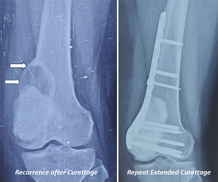 Joint preservation is sometimes possible even when Giant Cell Tumor of Bone recurs Joint preservation is sometimes possible even when Giant Cell Tumor of Bone recurs