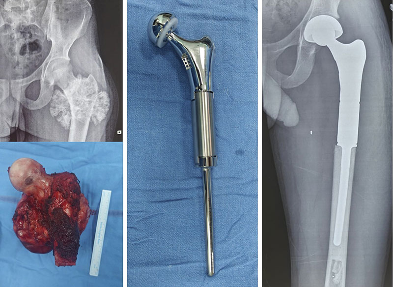 Limb-salvage surgery for a proximal femur bone tumor using a custom endoprosthetic reconstruction Limb-salvage surgery for a proximal femur bone tumor using a custom endoprosthetic reconstruction