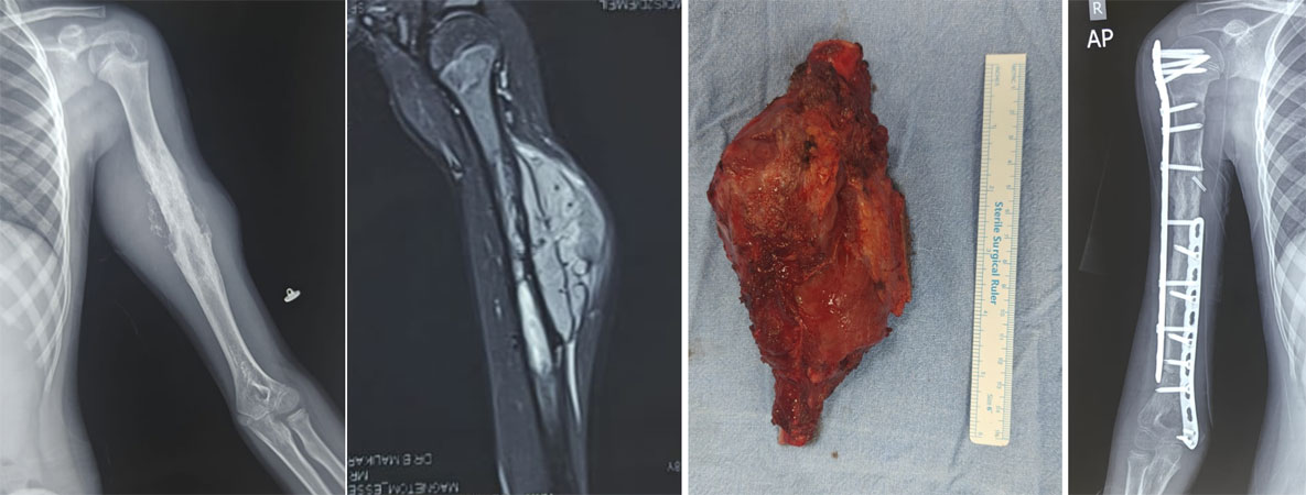 Limb-sparing treatment of Ewing sarcoma of the arm bone (humerus) Limb-sparing treatment of Ewing sarcoma of the arm bone (humerus)