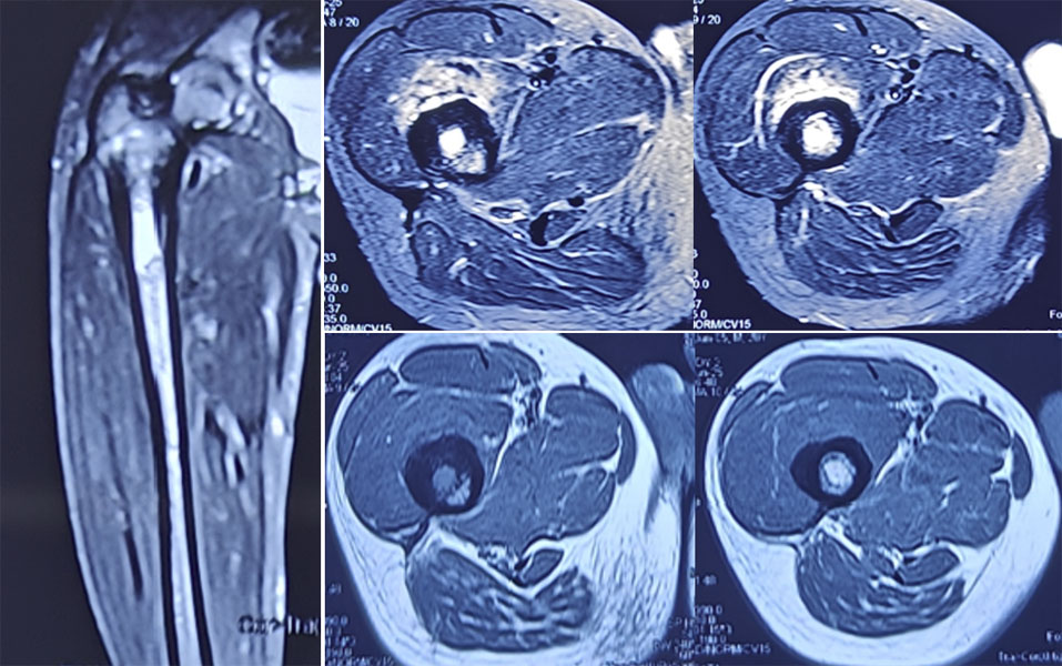MRI after chemotherapy for Ewing sarcoma of the femur MRI after chemotherapy for Ewing sarcoma of the femur