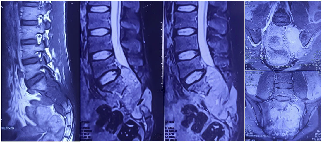 MRI appearance of a sacral chordoma MRI appearance of a sacral chordoma