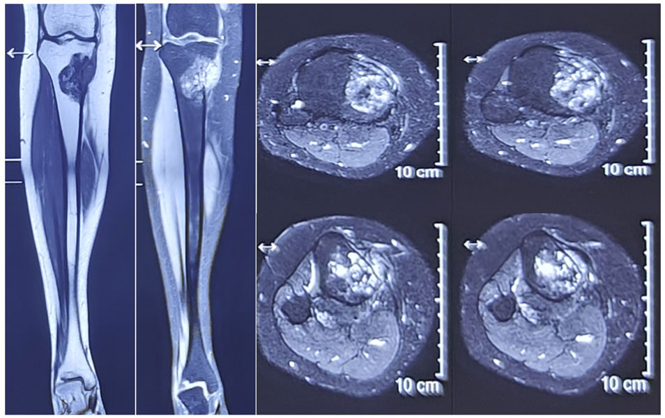 MRI assessment of a bone tumor around the knee