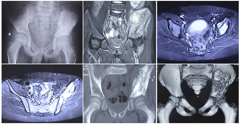 MRI assessment of a pelvic bone tumor, demonstrating its relationship to the hip joint and surrounding structures MRI assessment of a pelvic bone tumor, demonstrating its relationship to the hip joint and surrounding structures