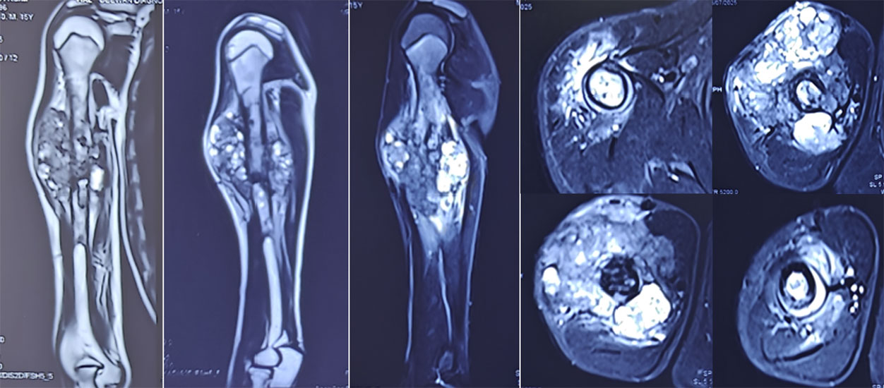MRI assessment of osteosarcoma MRI assessment of osteosarcoma