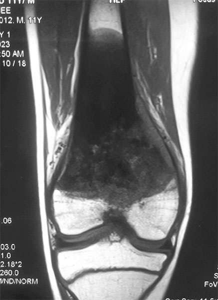 MRI before biopsy helps define the bone tumor and plan a safe and appropriate biopsy approach