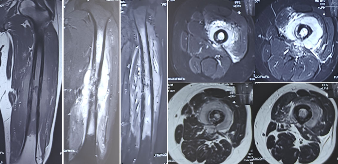 MRI evaluation of Ewing sarcoma MRI evaluation of Ewing sarcoma