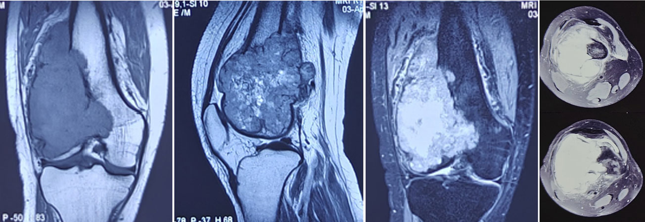 MRI evaluation of a bone tumor around the knee