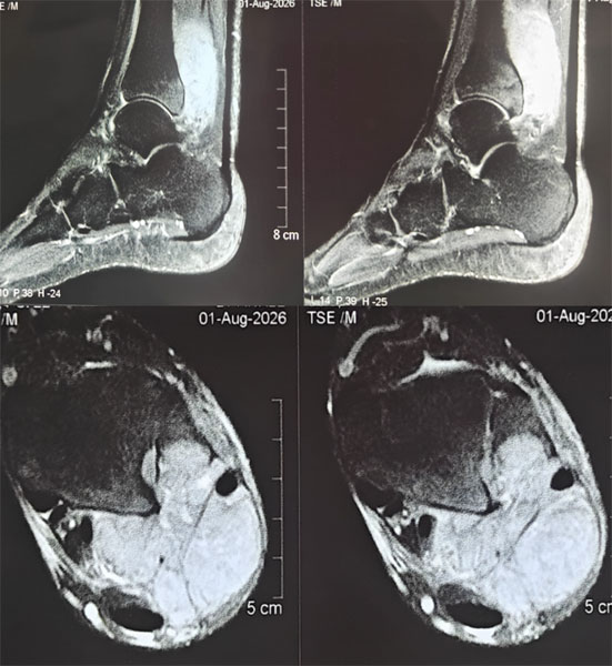 MRI evaluation of a soft tissue sarcoma around the ankle MRI evaluation of a soft tissue sarcoma around the ankle