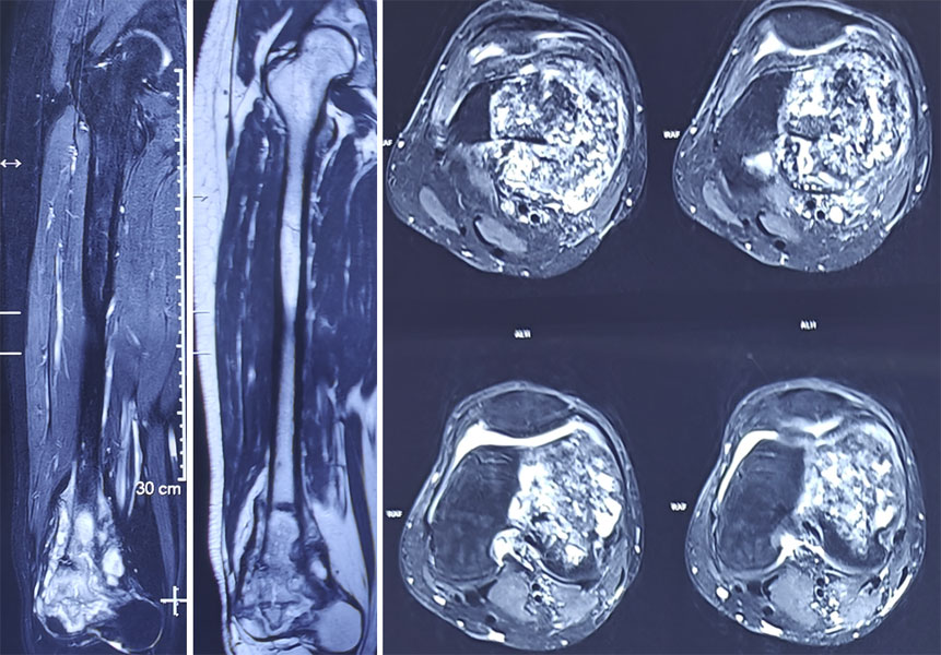 MRI evaluation of osteosarcoma MRI evaluation of osteosarcoma