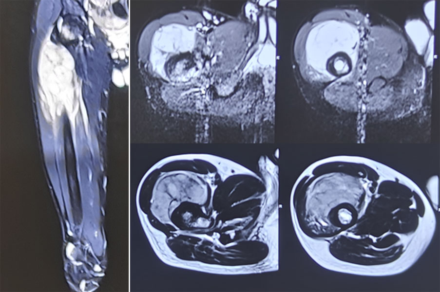 MRI of Ewing sarcoma of the femur before chemotherapy MRI of Ewing sarcoma of the femur before chemotherapy