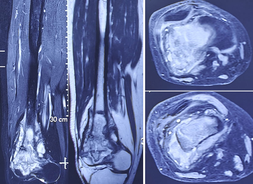 MRI of a distal femur osteosarcoma, showing the extent of the tumour and its relationship to surrounding structures. Careful MRI assessment helps plan safe limb-salvage surgery while achieving adequate tumour removal MRI of a distal femur osteosarcoma, showing the extent of the tumour and its relationship to surrounding structures. Careful MRI assessment helps plan safe limb-salvage surgery while achieving adequate tumour removal