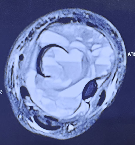MRI of an aneurysmal bone cyst (ABC) 