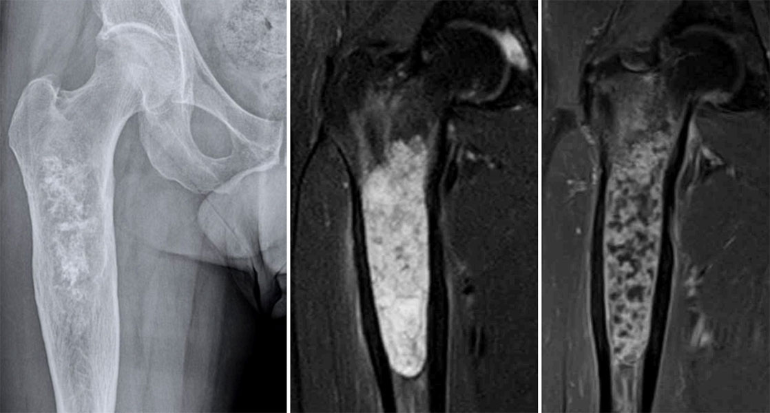 MRI of chondrosarcoma of the femur MRI of chondrosarcoma of the femur