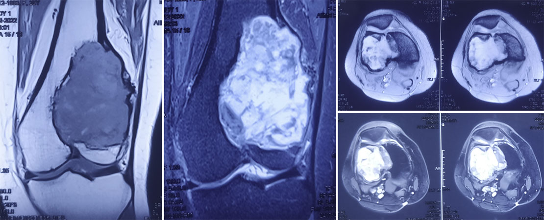 MRI provides a detailed view of the giant cell tumor, showing its extent within the bone and surrounding soft tissues MRI provides a detailed view of the giant cell tumor, showing its extent within the bone and surrounding soft tissues