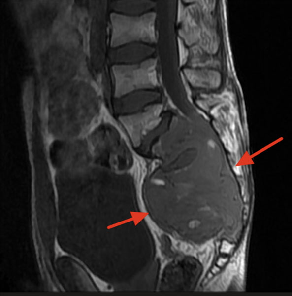 MRI showing a chordoma of the sacrum MRI showing a chordoma of the sacrum