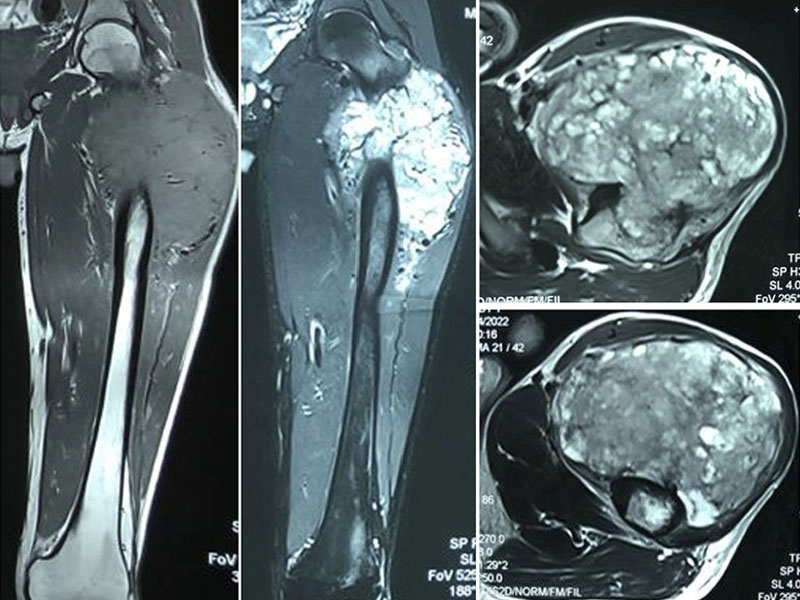 MRI showing the extent of a bone tumor around the hip, helping plan safe tumor removal MRI showing the extent of a bone tumor around the hip, helping plan safe tumor removal