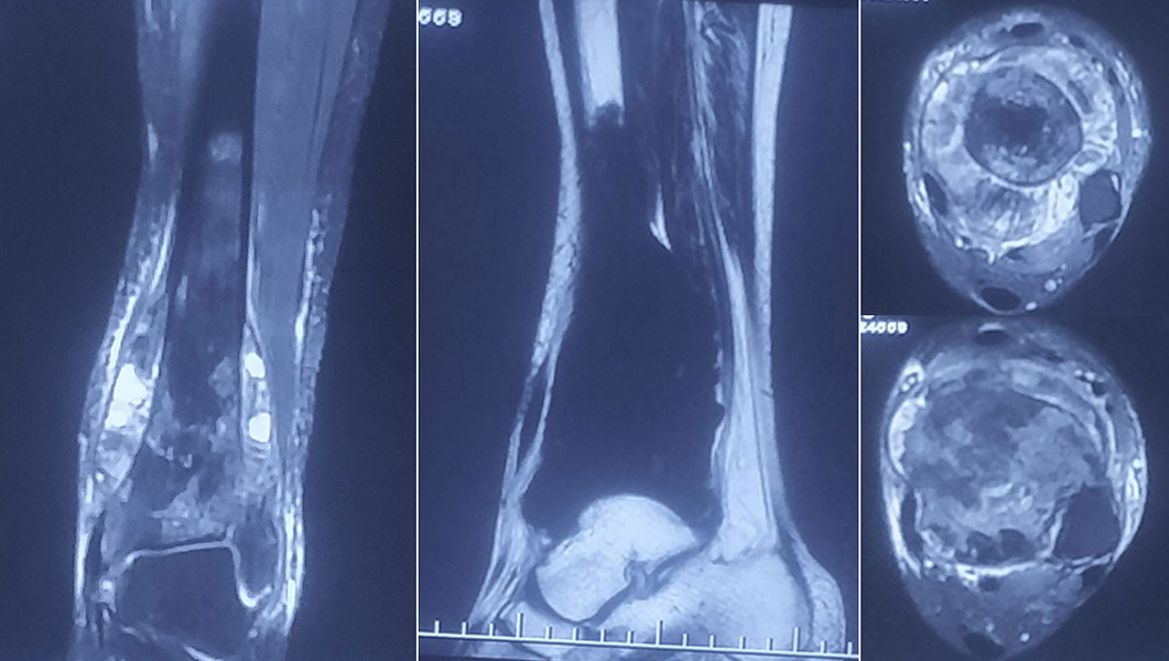MRI Seeing the tumour in three dimensions MRI Seeing the tumour in three dimensions