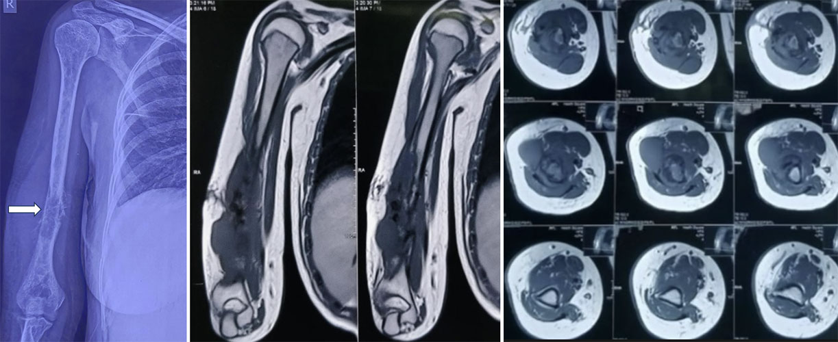 Malignant bone tumor of the lower humerus extending to the elbow joint, requiring careful surgical planning to achieve tumor-free margins while preserving arm function