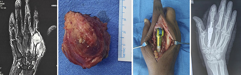 Metacarpal tumor resection with custom 3D-printed reconstruction Metacarpal tumor resection with custom 3D-printed reconstruction