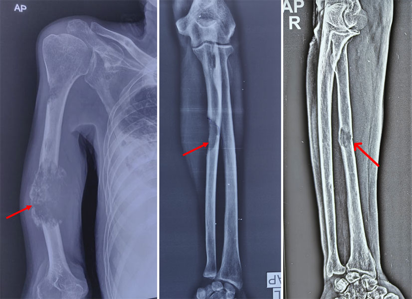 Metastatic bone lesions involving the humerus and forearm bones, showing how cancer from another organ can spread to the arm