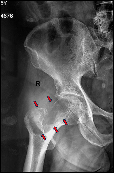 Metastatic bone tumor involving the proximal femur, a common location for secondary bone cancer Metastatic bone tumor involving the proximal femur, a common location for secondary bone cancer
