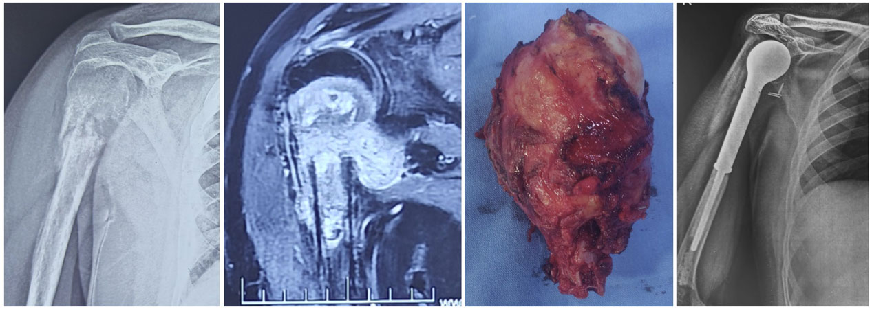 Metastatic thyroid cancer involving the proximal humerus treated with wide resection and endoprosthetic reconstruction Metastatic thyroid cancer involving the proximal humerus treated with wide resection and endoprosthetic reconstruction
