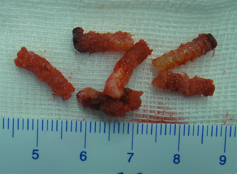 Multiple tissue cores are obtained during a core needle biopsy to improve diagnostic accuracy