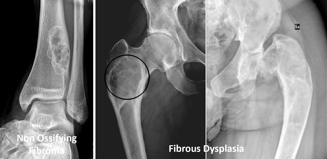 Non-ossifying fibroma and fibrous dysplasia Non-ossifying fibroma and fibrous dysplasia