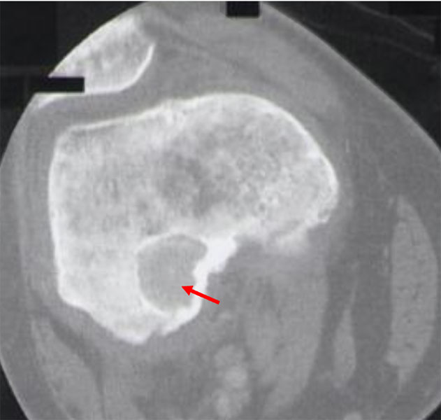 Osteoblastoma of the distal femur Osteoblastoma of the distal femur