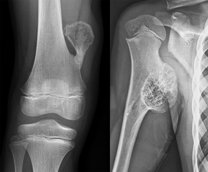 Osteochondroma, a common benign bone growth arising near the growth plate of a growing bone Osteochondroma, a common benign bone growth arising near the growth plate of a growing bone