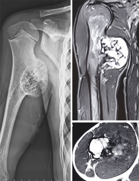Osteochondroma arising from the humerus (upper arm bone), a common benign bone tumor that may present as a painless lump
