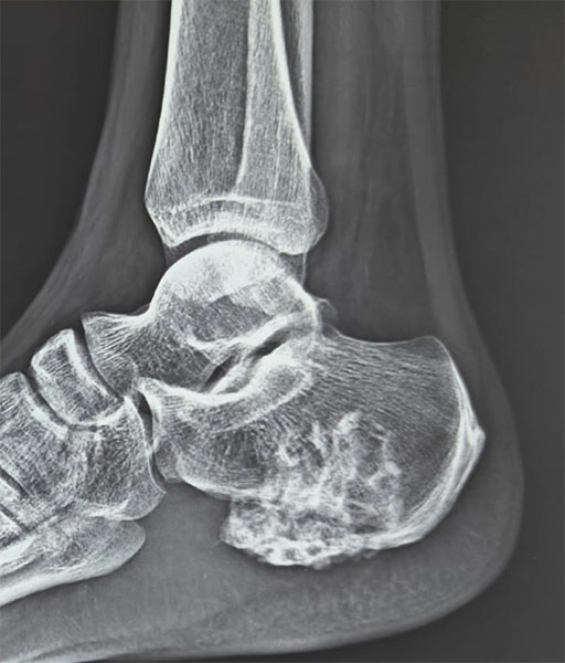 Osteochondroma of the ankle—a benign bone tumor arising near the ankle joint Osteochondroma of the ankle—a benign bone tumor arising near the ankle joint