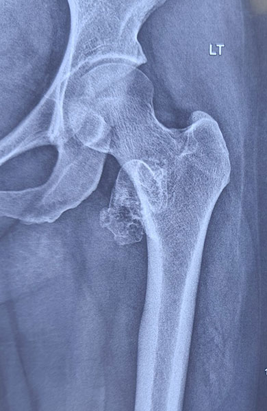 Osteochondroma of the proximal femur, a benign bone tumor arising near the hip Osteochondroma of the proximal femur, a benign bone tumor arising near the hip