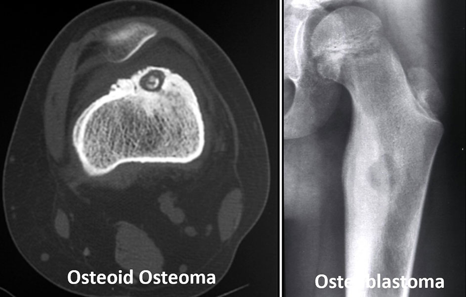 Osteoid osteoma and osteoblastoma Osteoid osteoma and osteoblastoma
