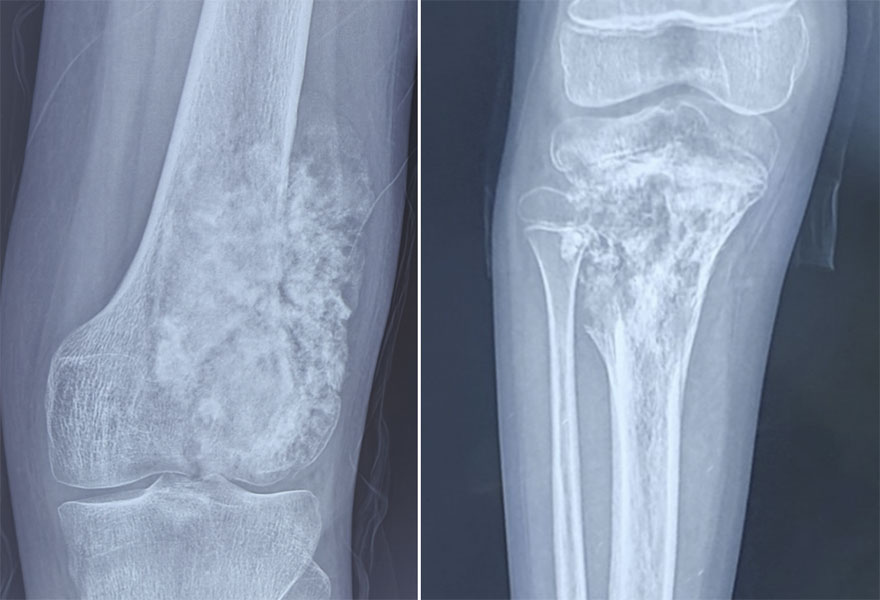 Osteosarcoma around the knee Osteosarcoma around the knee