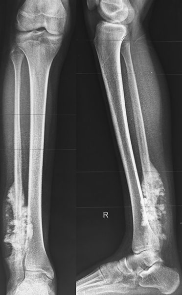 Osteosarcoma involving the distal tibia, illustrating the complex challenges of bone tumor surgery around the ankle Osteosarcoma involving the distal tibia, illustrating the complex challenges of bone tumor surgery around the ankle