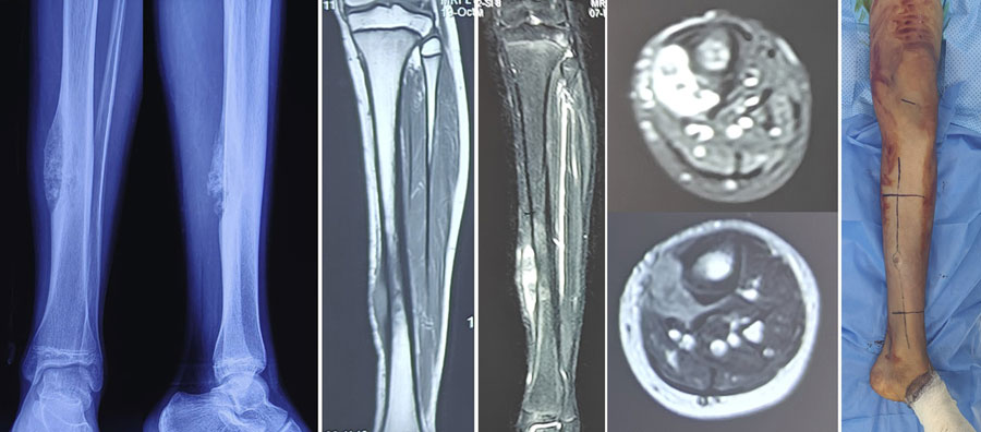 Osteosarcoma involving the shaft of the tibia, assessed with X-ray and MRI before surgery Osteosarcoma involving the shaft of the tibia, assessed with X-ray and MRI before surgery