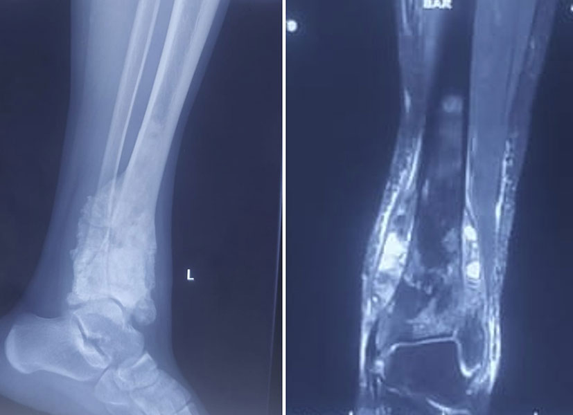 Osteosarcoma of the ankle—a malignant bone tumor requiring multidisciplinary cancer treatment Osteosarcoma of the ankle—a malignant bone tumor requiring multidisciplinary cancer treatment