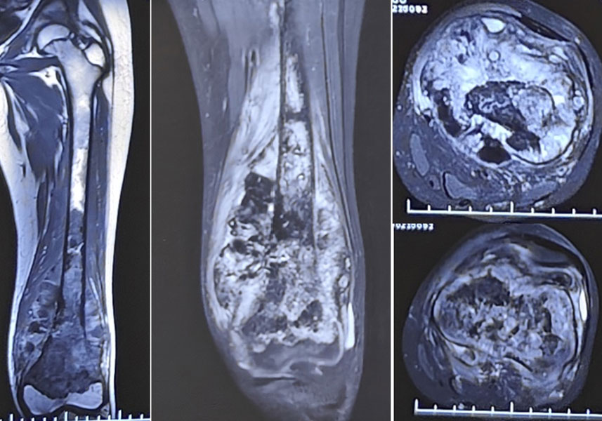 Osteosarcoma of the lower femur in a 12-year-old boy