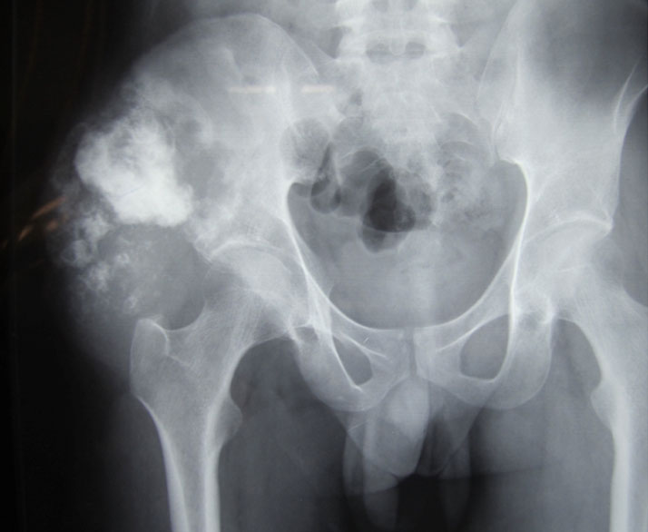Osteosarcoma of the pelvis Osteosarcoma of the pelvis